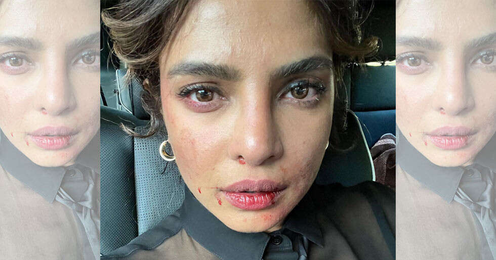 Priyanka Chopra Jonas shares a photo of her bruised face from the set of Citadel - Vimarsana News